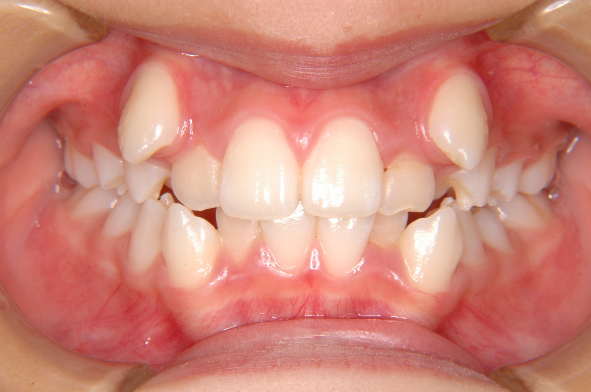 八重歯はかわいい 高崎の矯正歯科スマイルデザイン