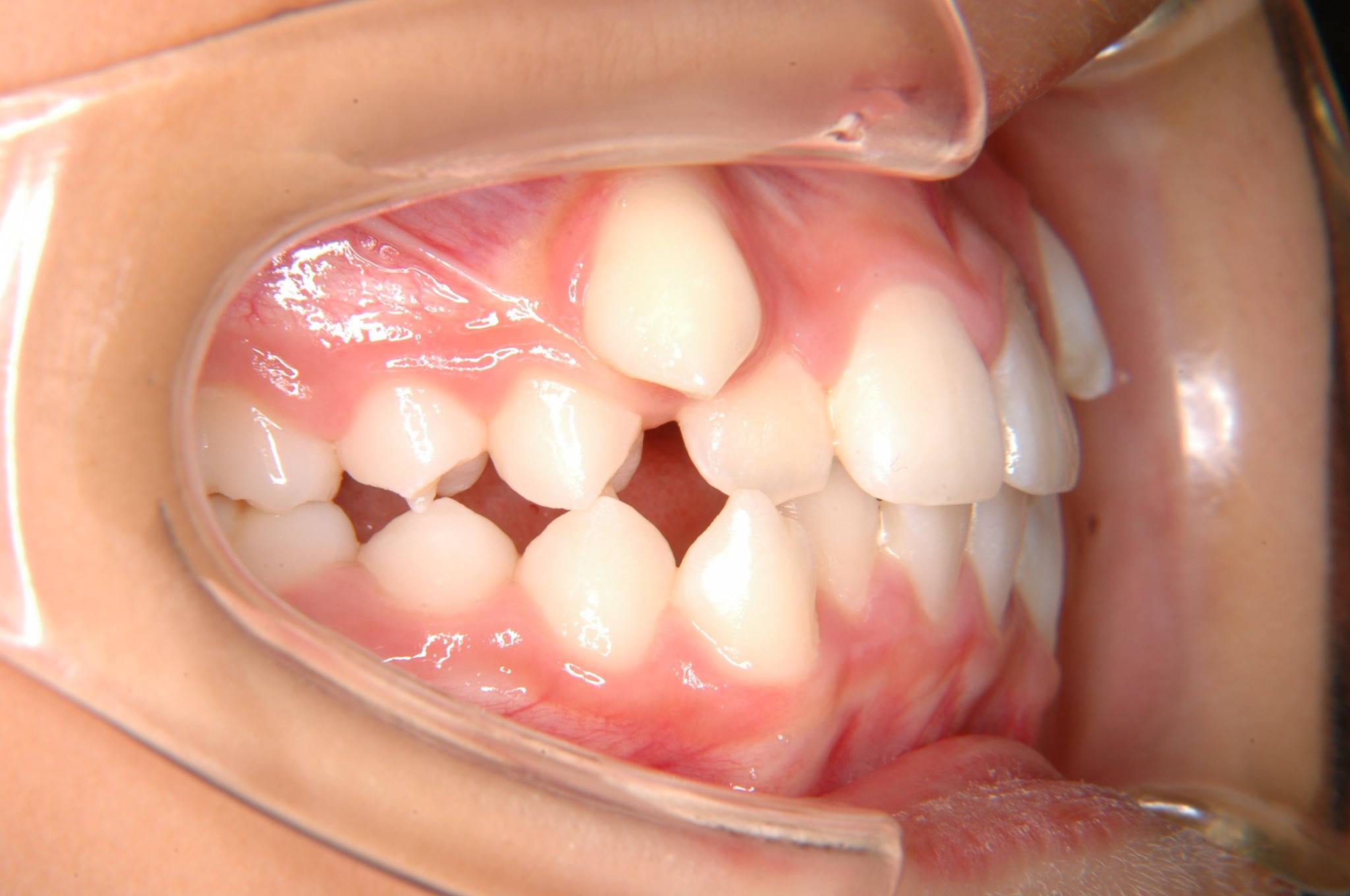 八重歯はかわいい 高崎の矯正歯科スマイルデザイン