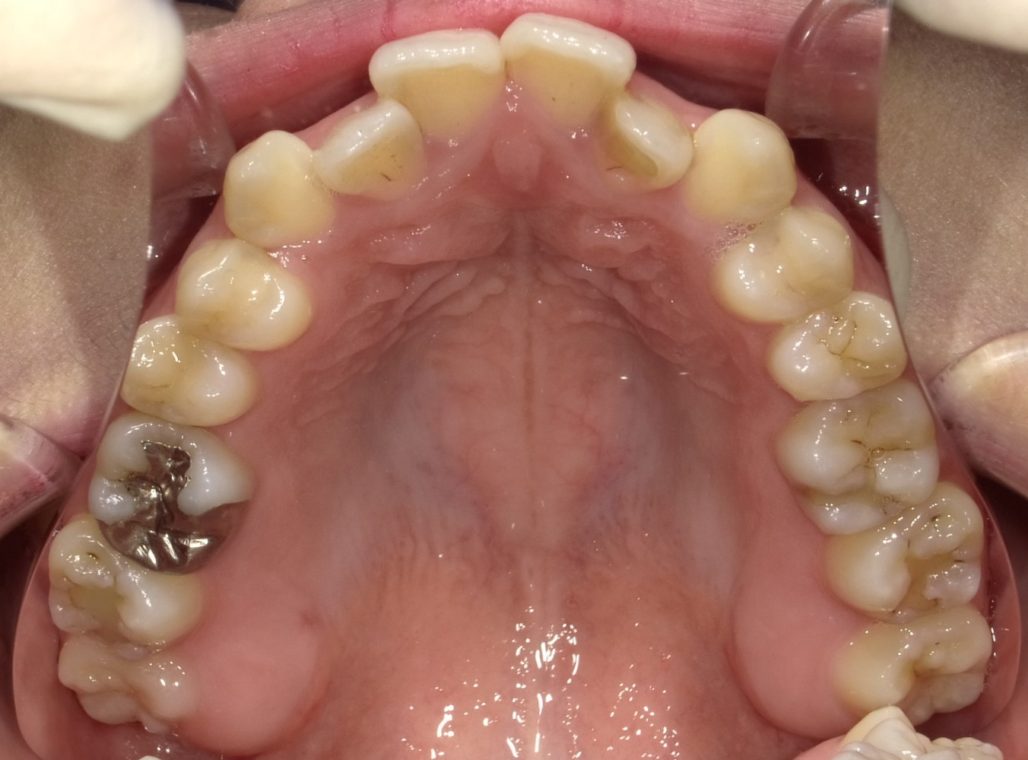27歳2ヶ月 女性 高崎の矯正歯科スマイルデザイン